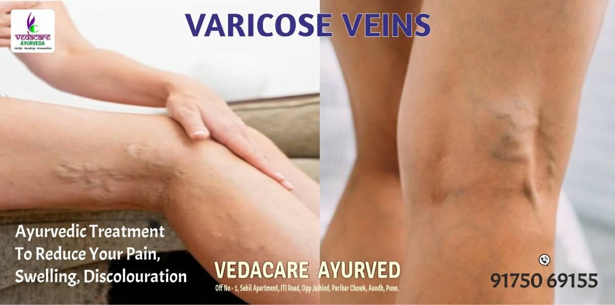 VERICOSE VEINS ayurvedic treatment
