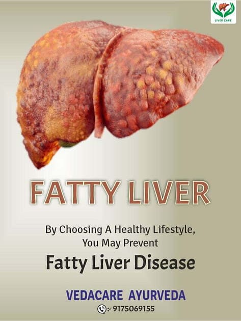 fatty liver ayurvedic cure treatment