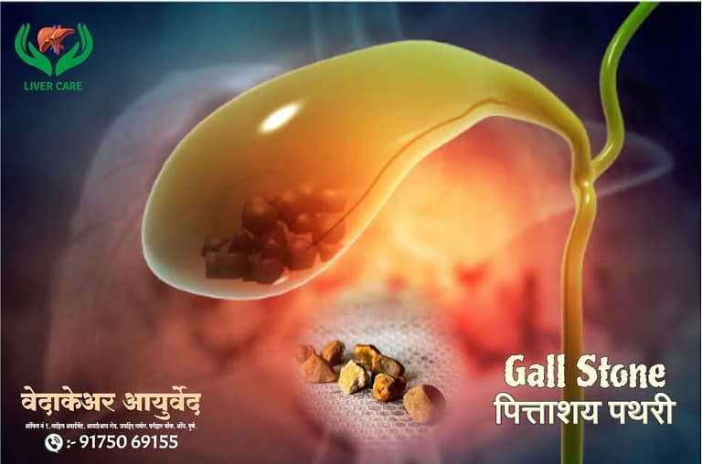 ayurvedic-treatment-for-gallstone-pittashay-khade