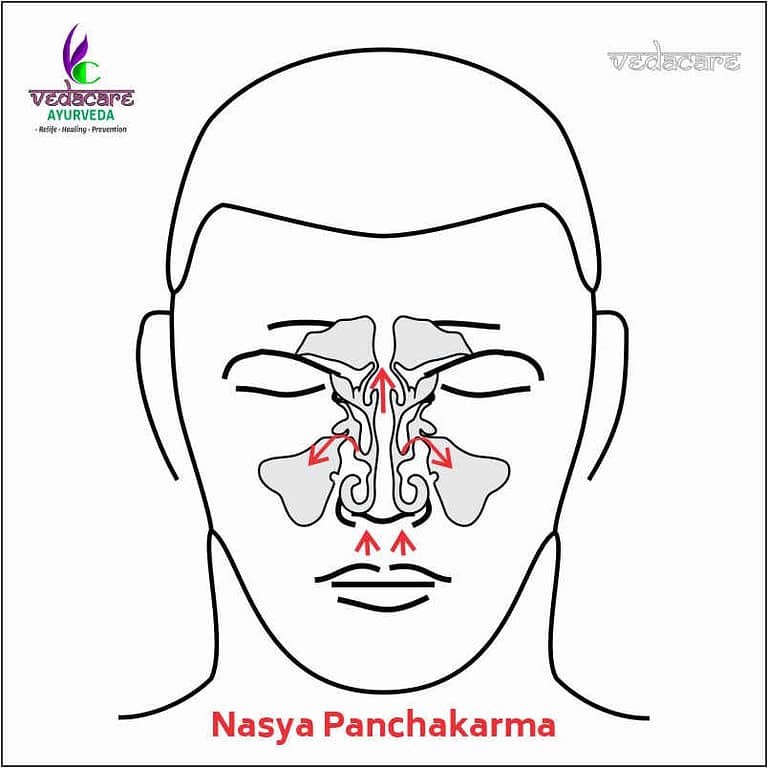 Nasya-panchakarma-clinic-in-aundh-baner-pune